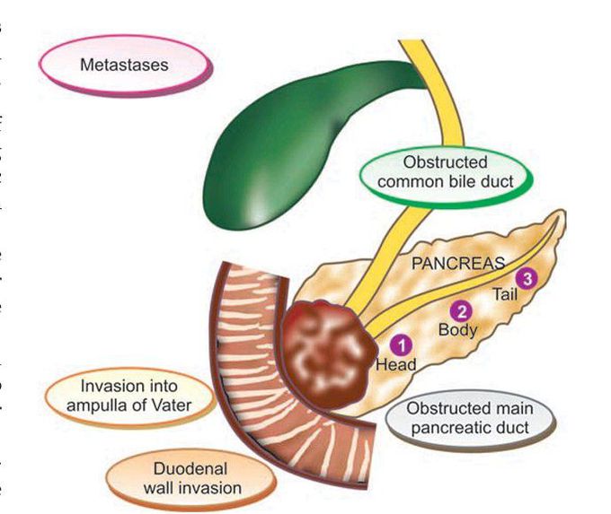 Carcinoma of the pancreas