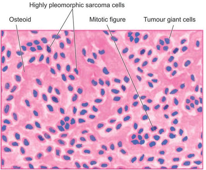 Osteosarcoma