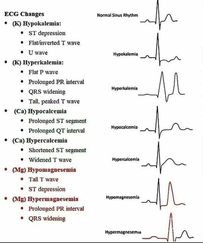 Snapshot of ECG changes  in electrolytes imbalance