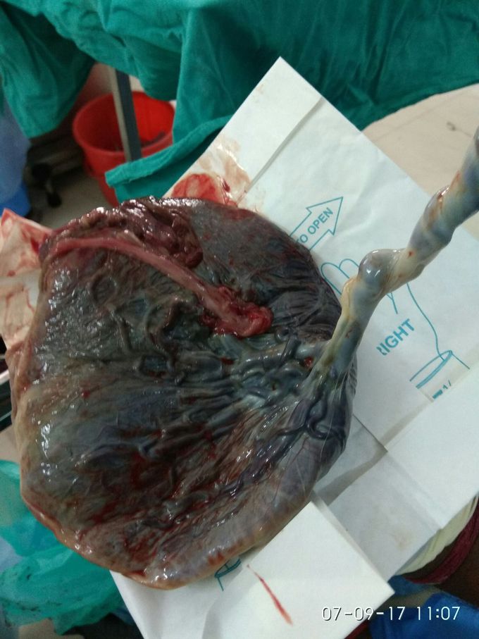 Battledore placenta