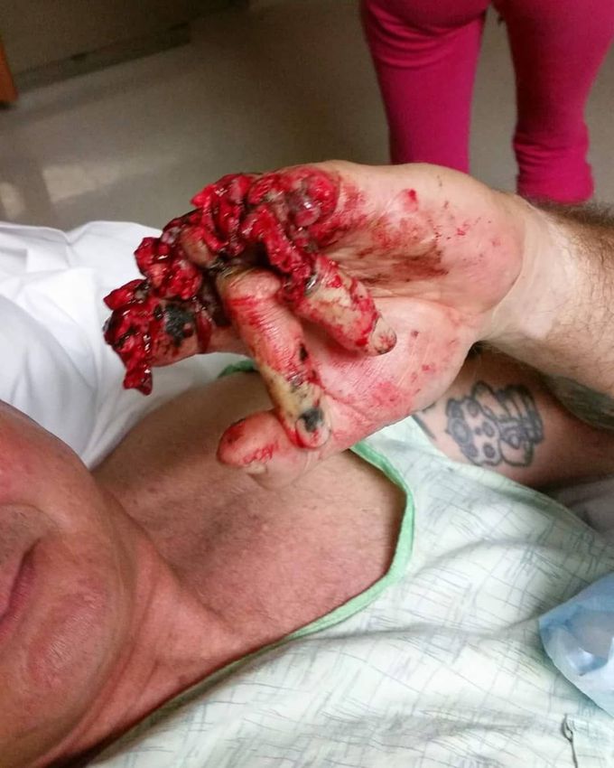 This patient suffered a chainsaw accident that led to multiple finger amputation