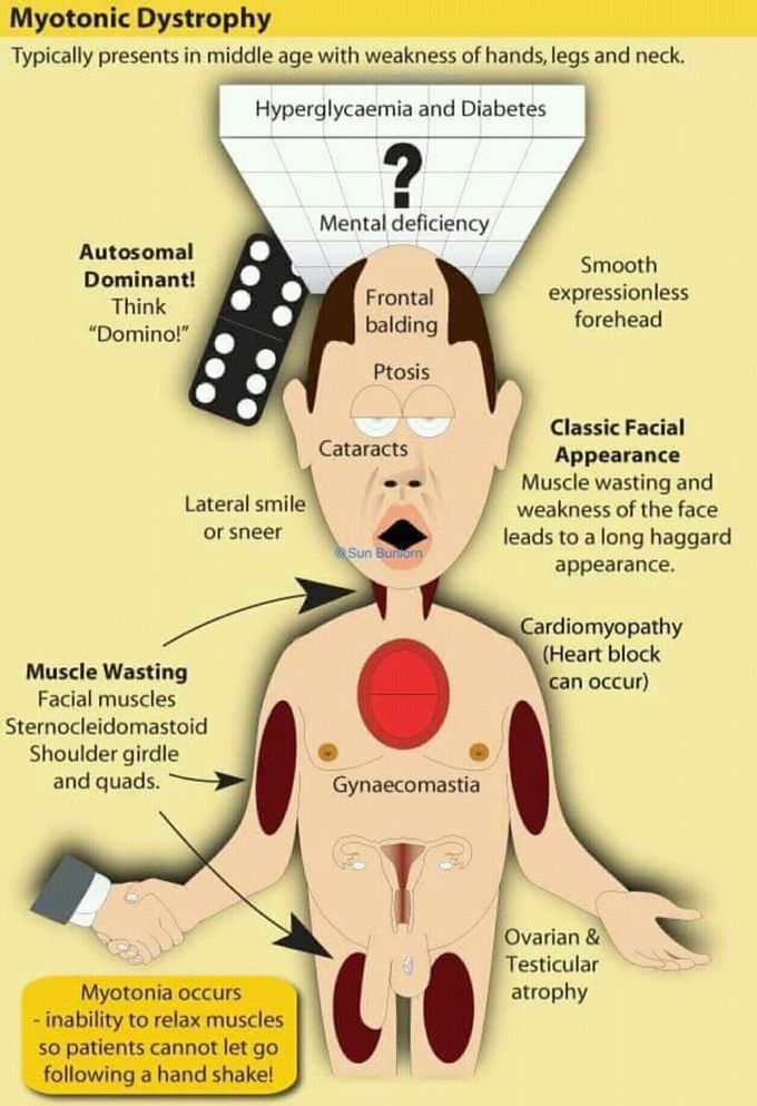 Mytonic Dystrophy