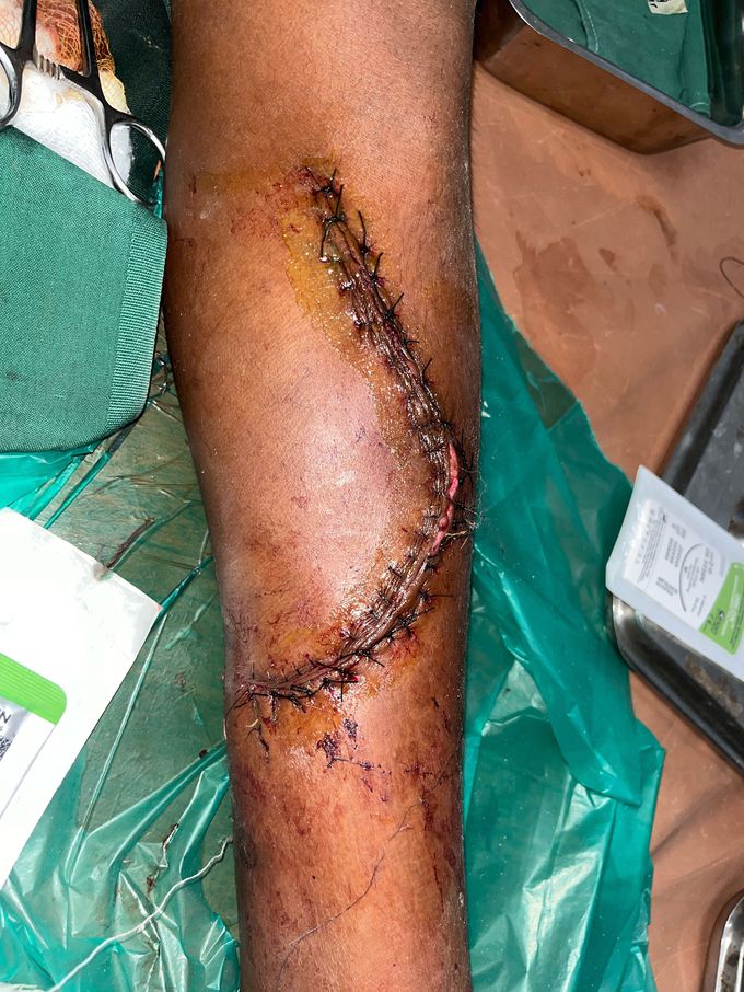 Suturing