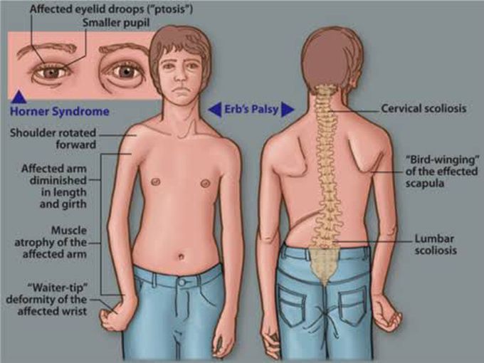 Erbs palsy definition