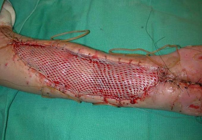What is the name of this surgery and when the surgeons do it 😏??