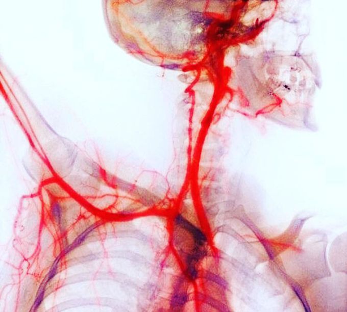 Coloured X-ray or arteriogram or angiogram of neck and shoulder arteries: 