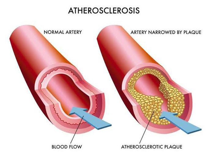 Arteriosclerosis