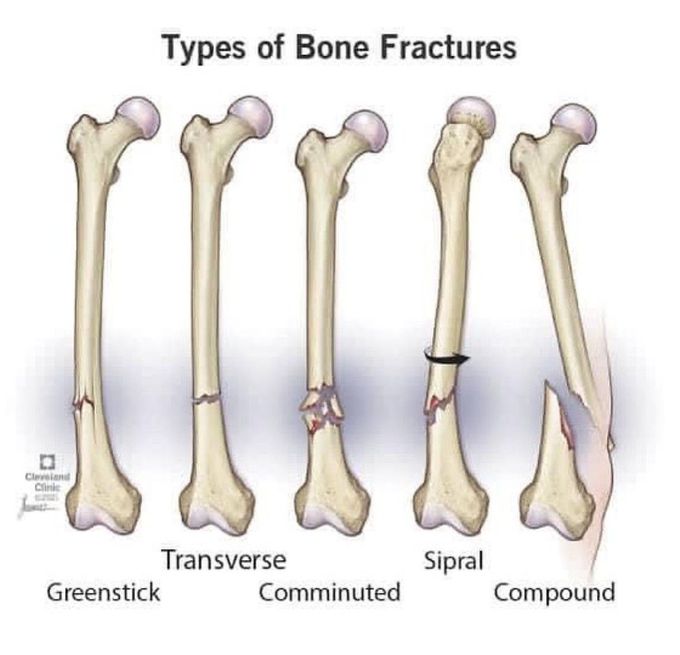 Types of Bone Fracture