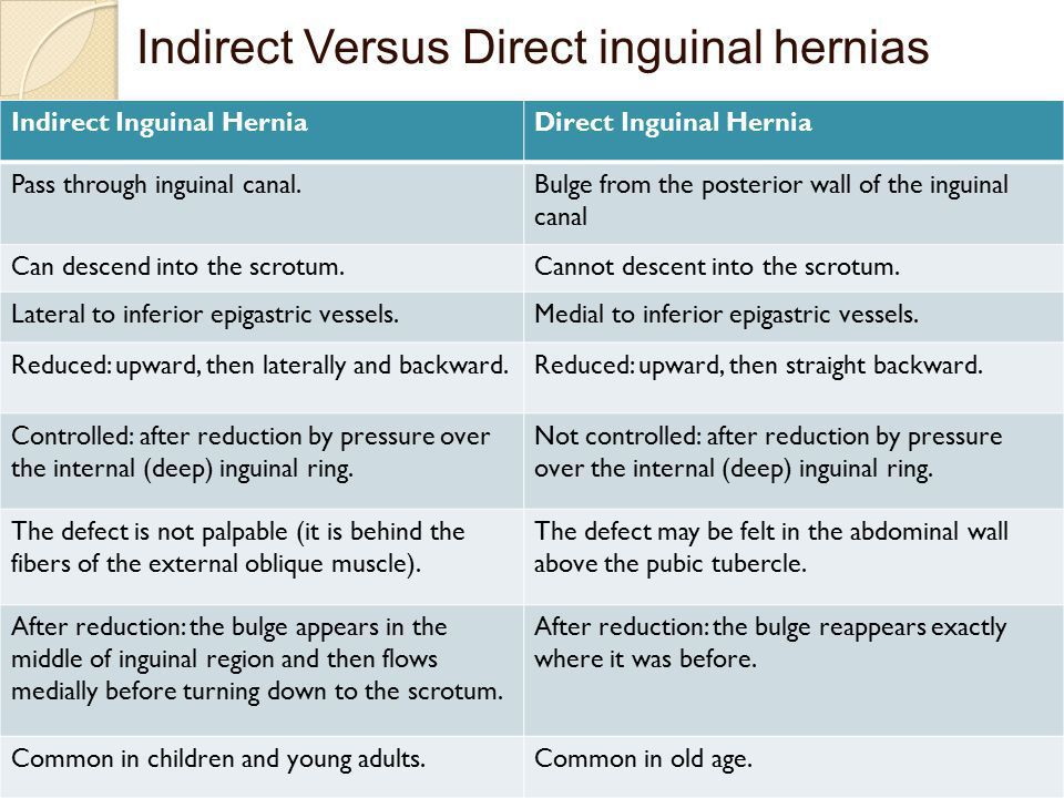 indirect vs direct inguinal hernia