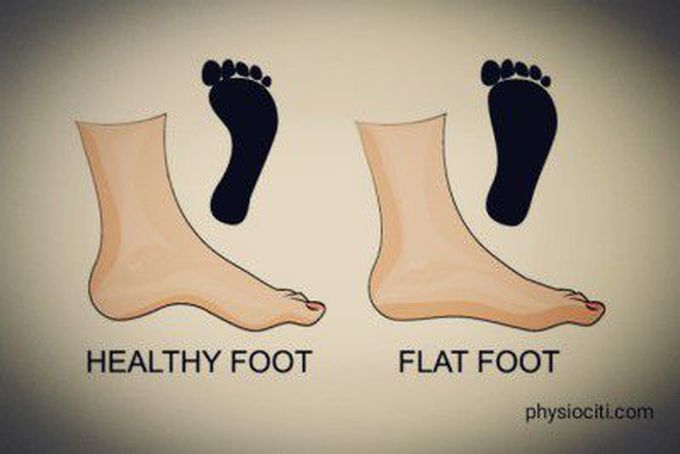 Flat Feet Exercises: Strengthen Fallen Arches! - physiociti