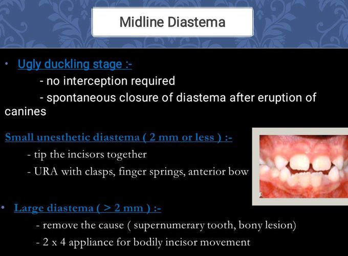 Midline Diastema- Management