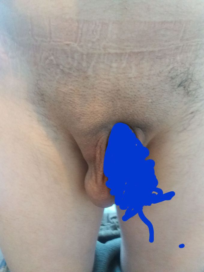 Hernia