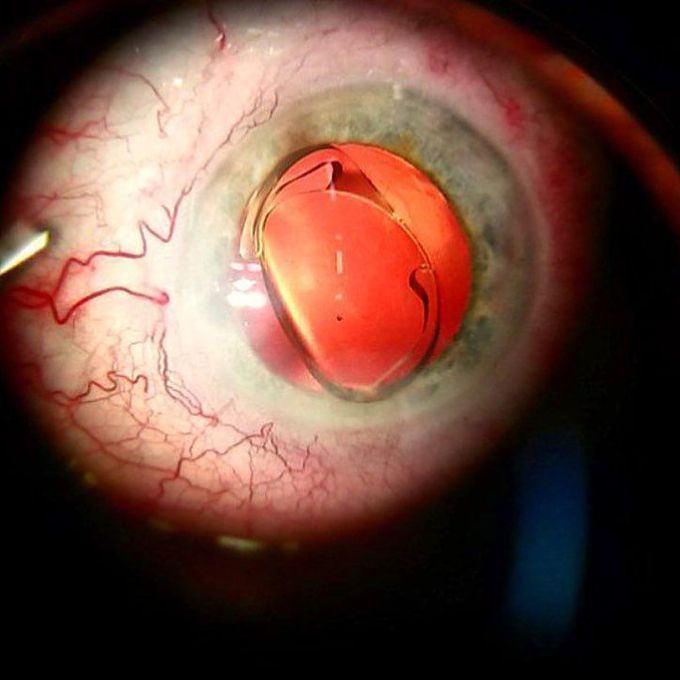 IOL unfolding inside the eye