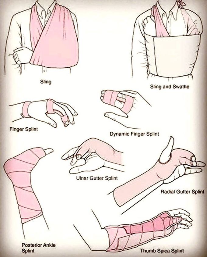 Splint