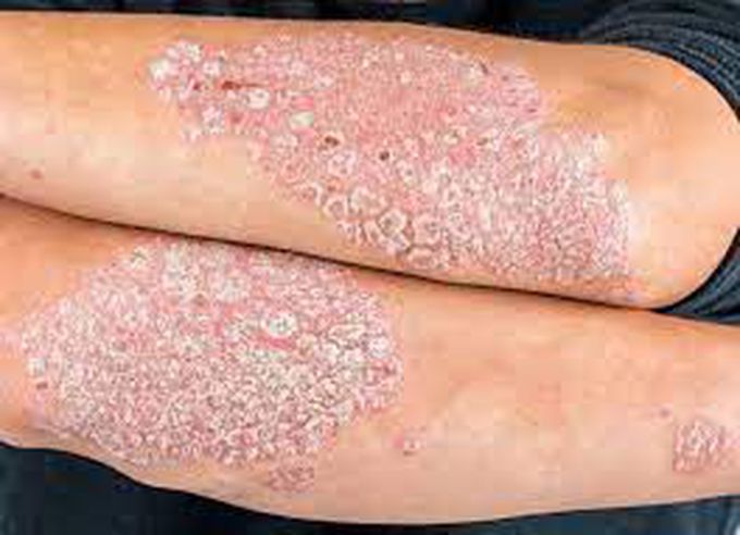 Symptoms of Psoriasis