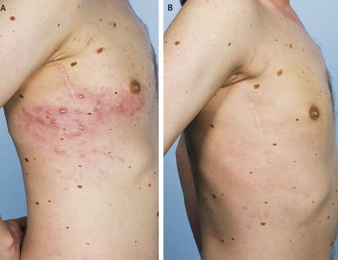 Zosteriform Metastases from Malignant Melanoma