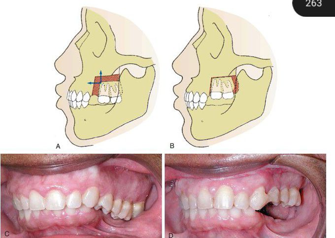 Segmental osteotomies