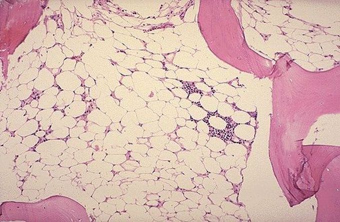 Which is the most common preceding infection in bone marrow failure syndromes?
A. Parvo B19
B. EBV
C. HIV
D. Hepatitis