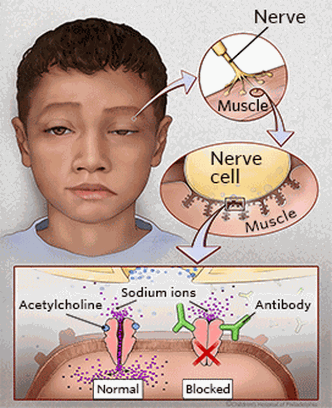 Myasthenia gravis