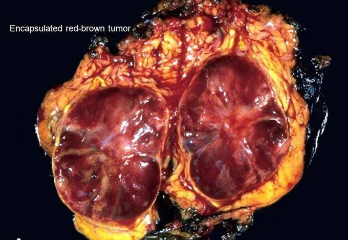 PHEOCHROMOCYTOMA (PCC)