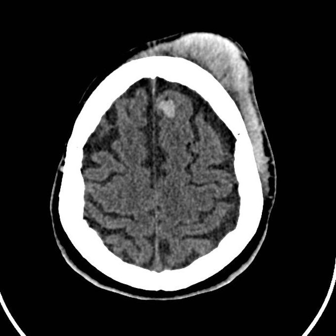 Subgaleal Hematoma