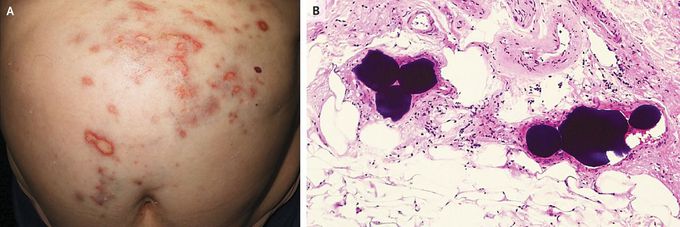 Skin Necrosis after Transarterial Chemoembolization