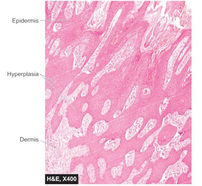 Pseudocarcinomatous hyperplasia of the skin.