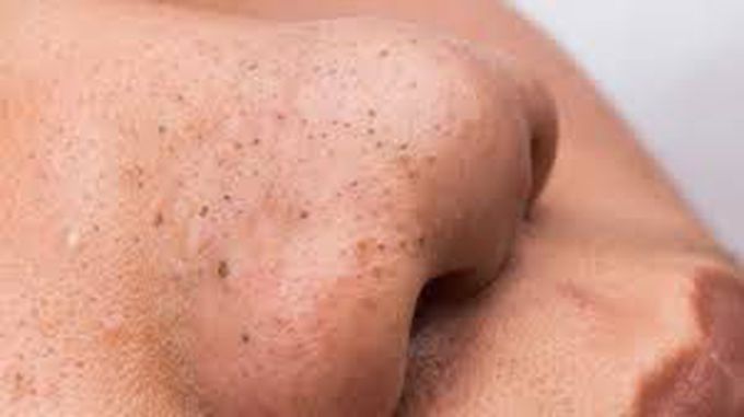 Black heads