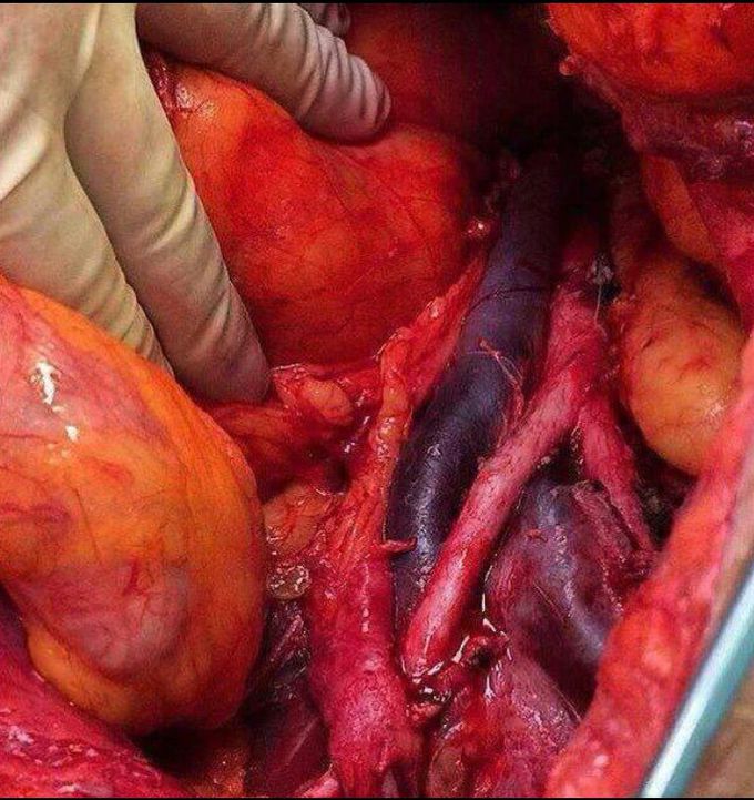Aorta & Inferior cava vena 😍😍