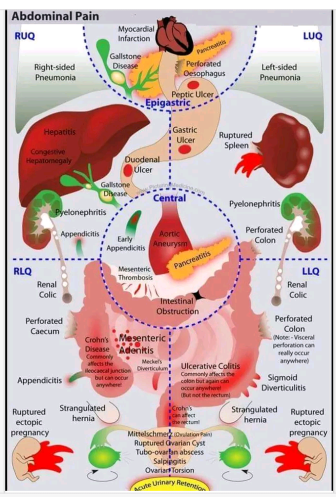 Abdominal pain