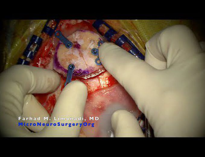 Surgery for resection of two brain tumors originating from kidney (renal cancer): Keyhole surgery.