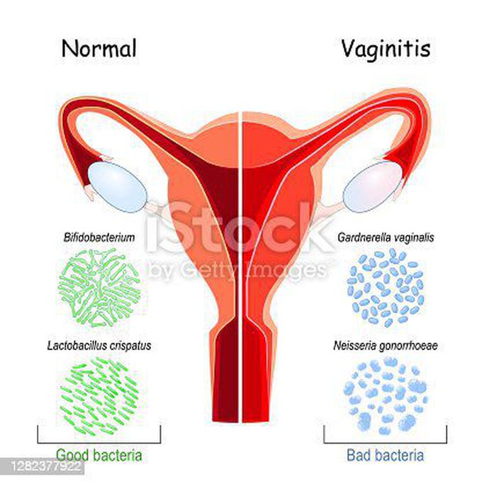 Symptoms of vaginitis