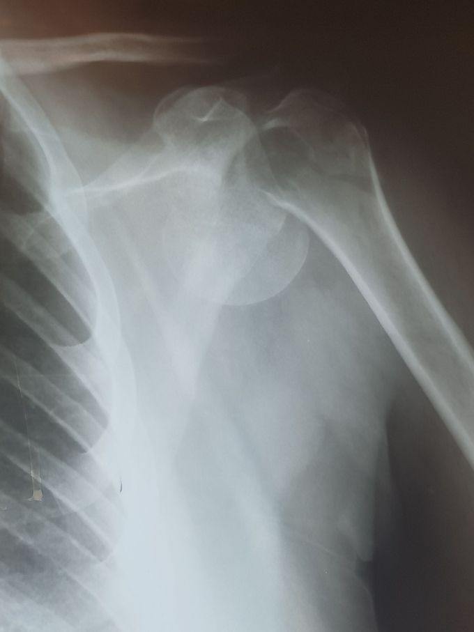 proximal humerus fracture