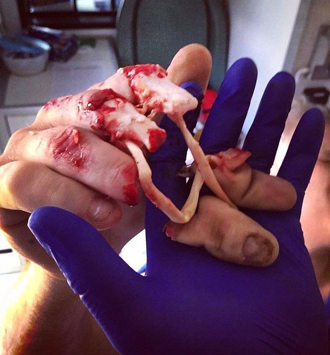 Degloved fingers