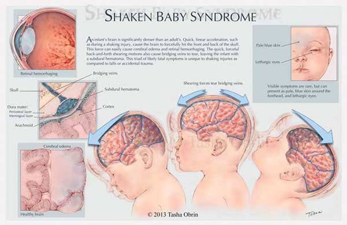 Shaken baby syndrome