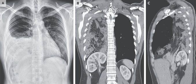 Congenital Diaphragmatic Hernia in an Adult
