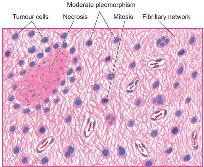 Anaplastic astrocytoma