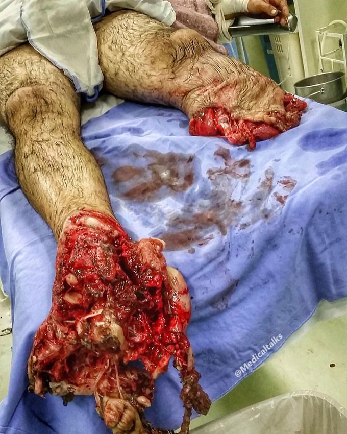 Trauma but life saved!! A 45-year-old truck driver crash victim (Truck VS Truck)!! 