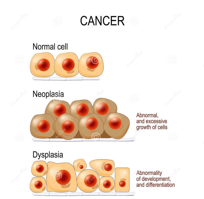 Neoplasia and dy