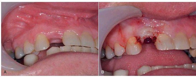 Implant uncovering