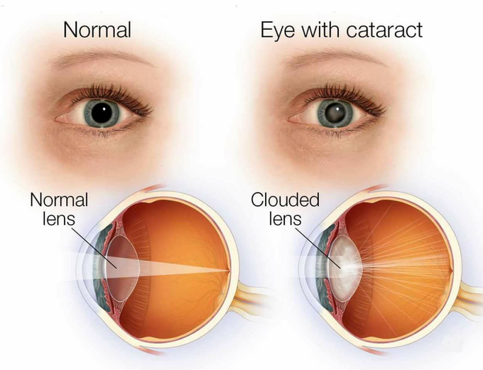 How do Corticosteroids cause cataract ?
What is the mechanism ?