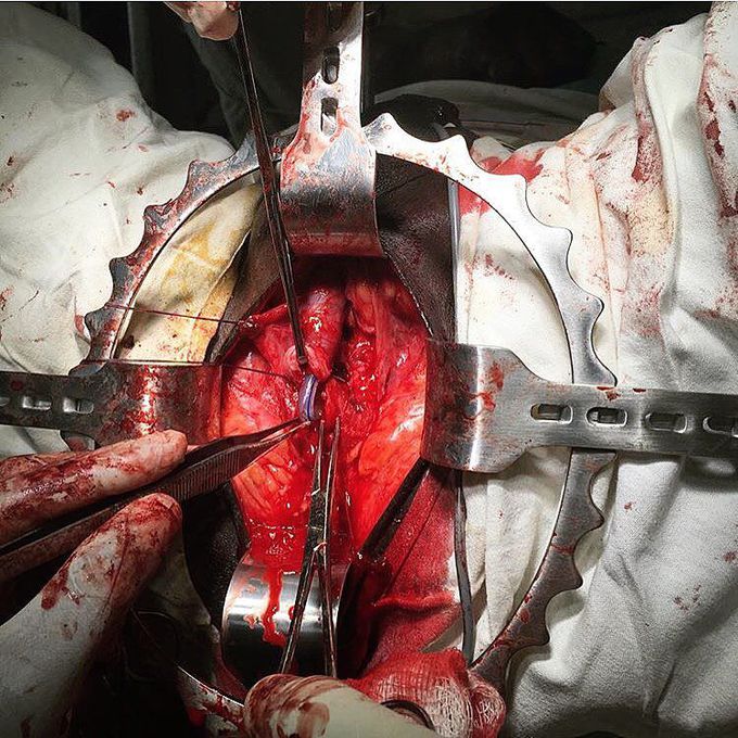 Open reconstruction of the urethra