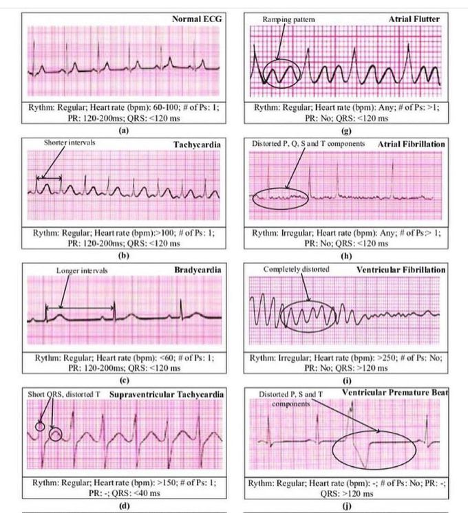 ECG Changes