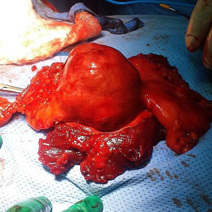 Fibrosarcoma of the rectus abdominis muscle in a 30 year-old patient