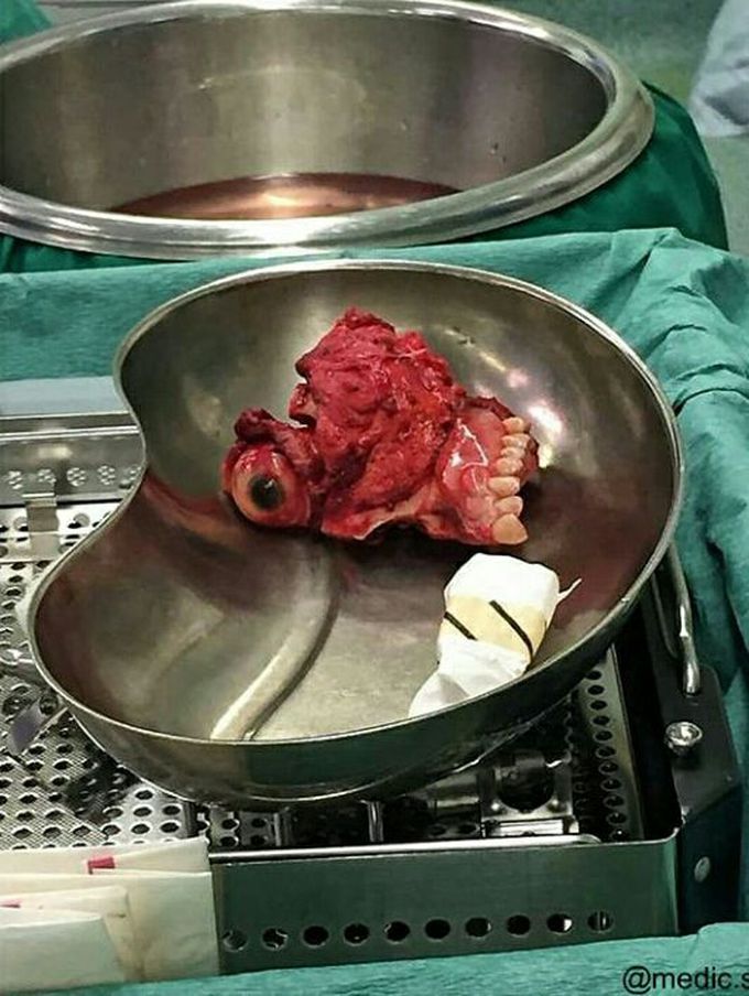 Maxillectomy