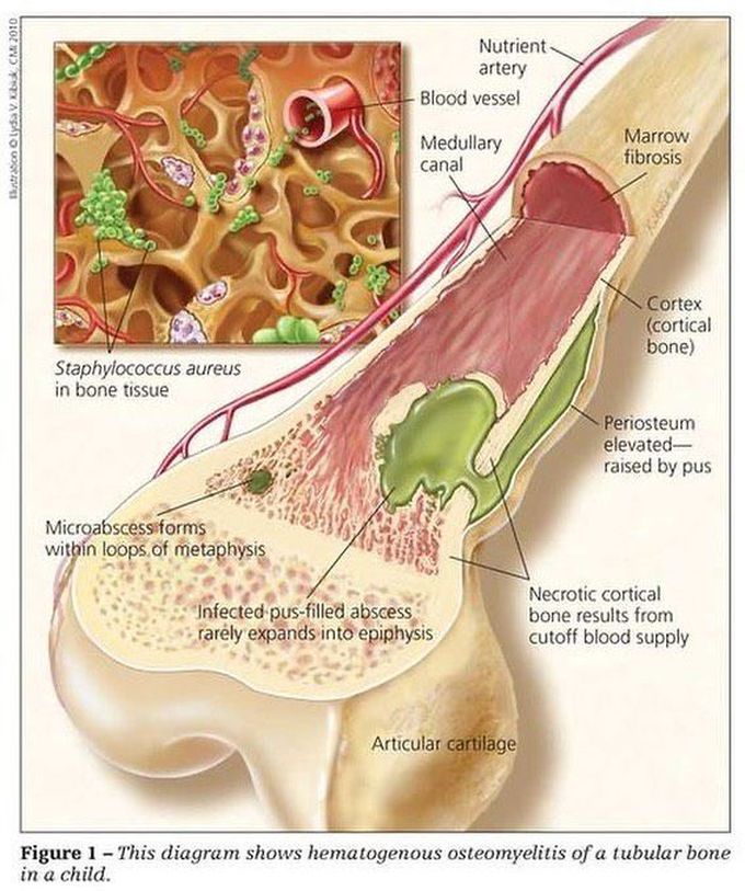 Hematogenous osteomyelitis