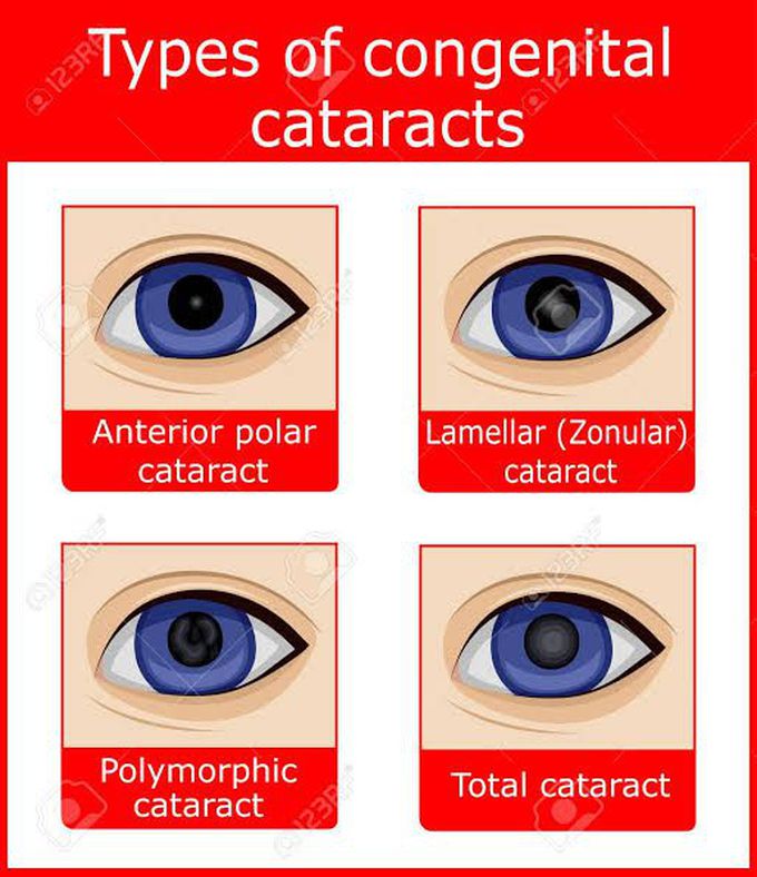 Congenital Cataract-Types