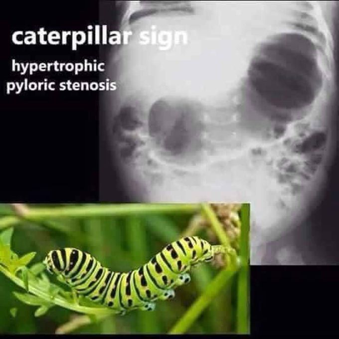 Hypertohic Pyloric Stenosis (radiology)