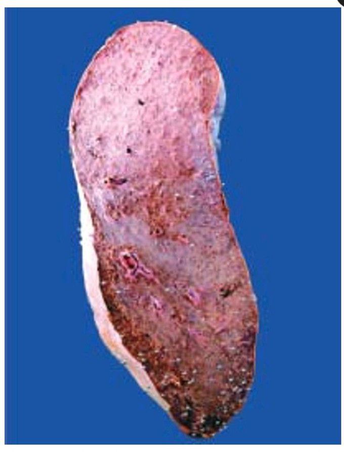 CVC spleen (Congestive splenomegaly).