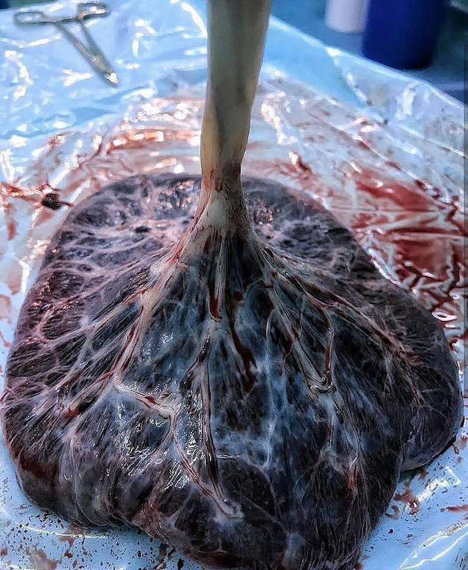 The tree of life- Placenta